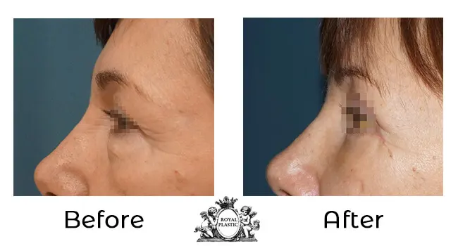 Горна и долна блефаропластика — случай 5